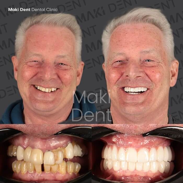 all on 4 dental implants before after image