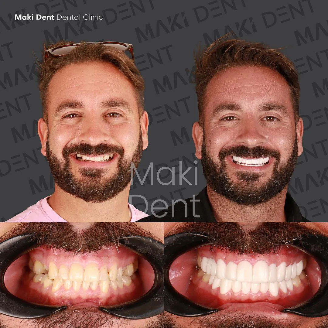 full mouth dental implants before after image