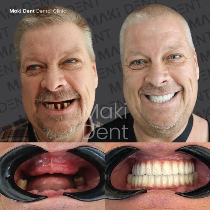 all on six dental implants before after image
