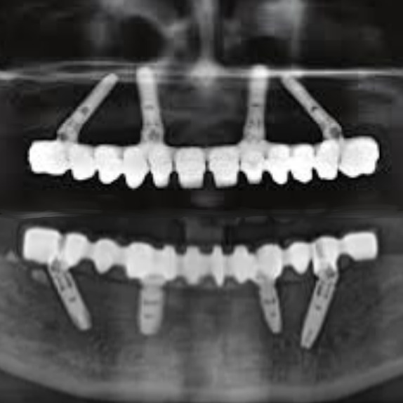 all on four dental implants Turkey