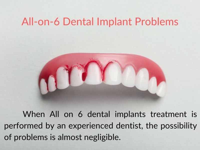 All-on-6 Dental Implant Problems