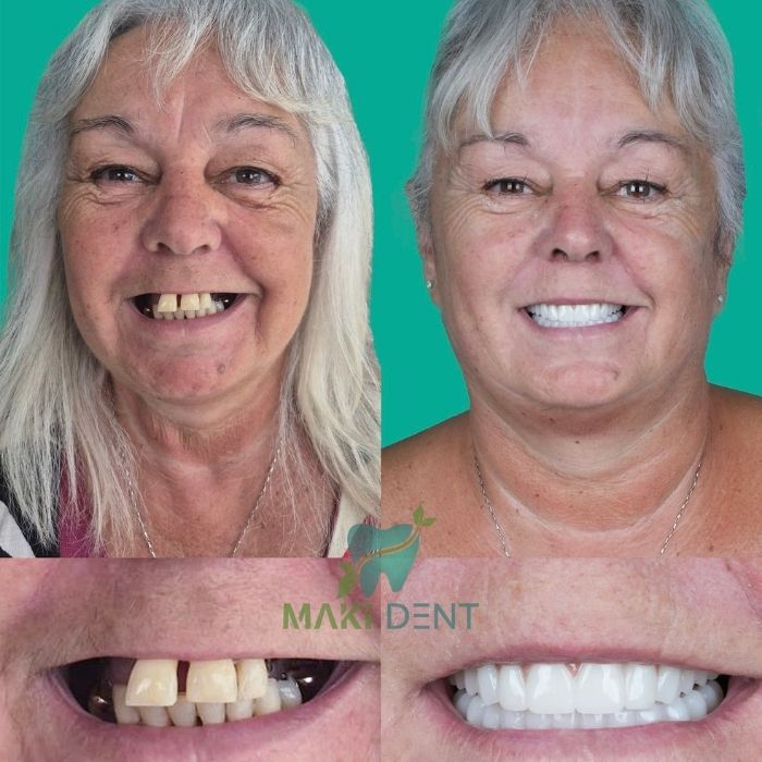 all on 4 dental implants Turkey