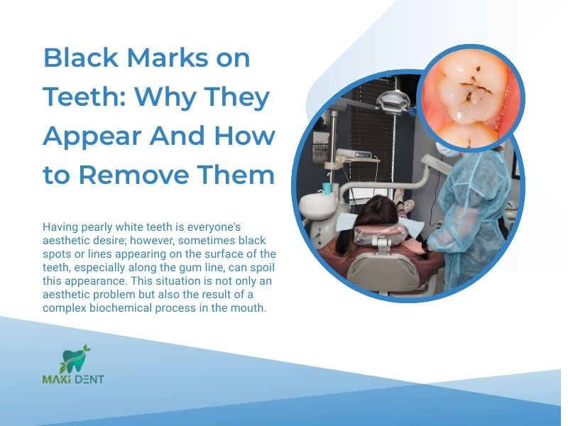 Black marks on teeth