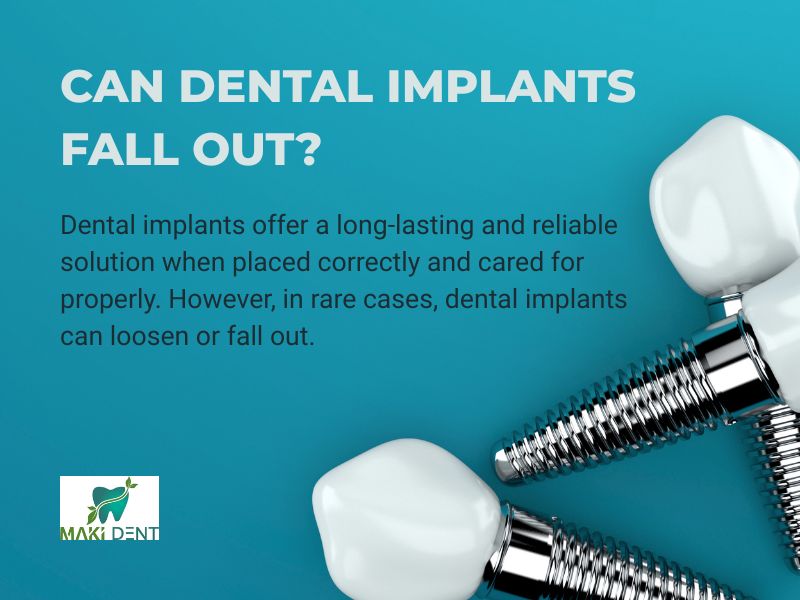 Can Dental Implants Fall Out?
