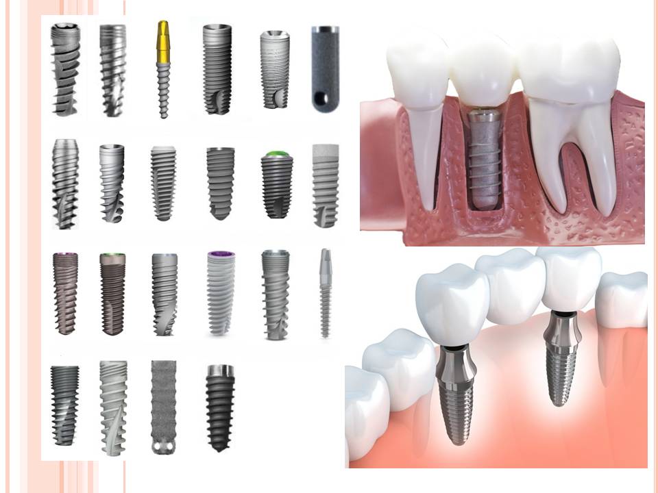 Dental Implant Brands to Avoid for Long-Term Safety