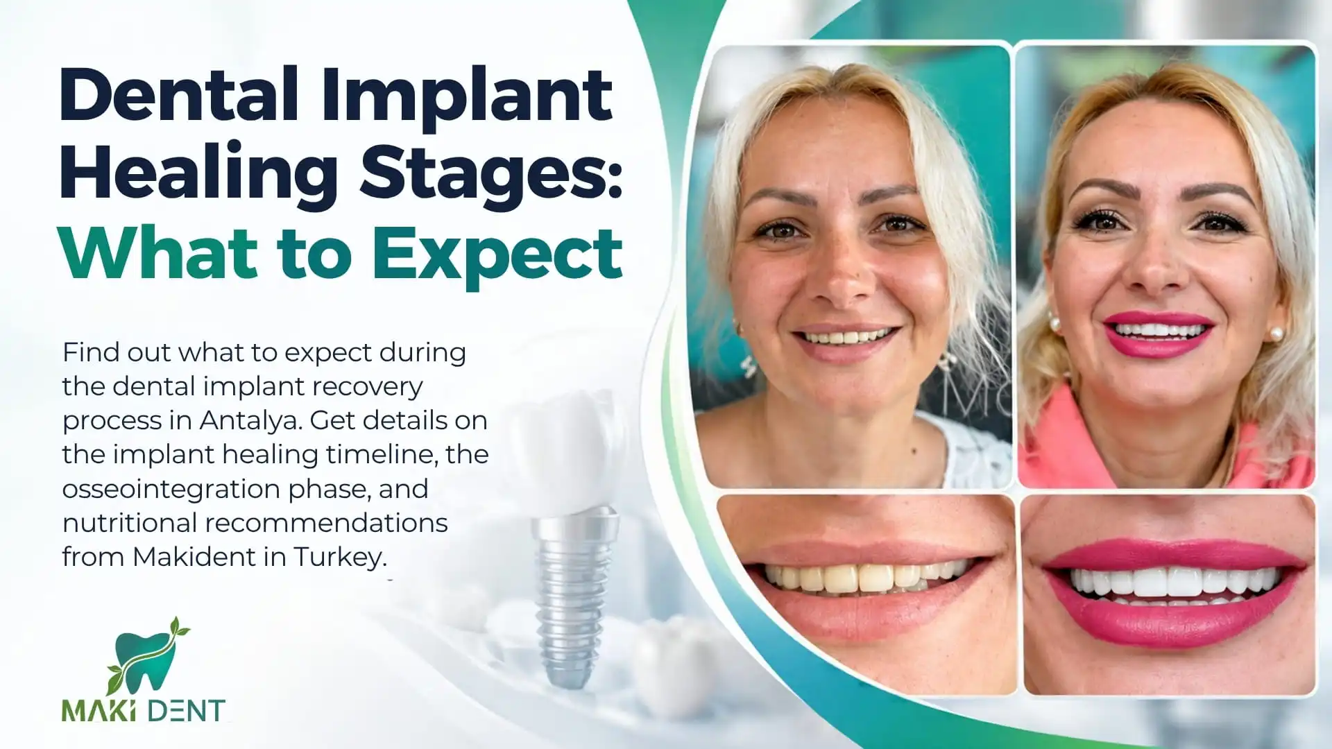 Dental implant healing stages in Antalya, Turkey 