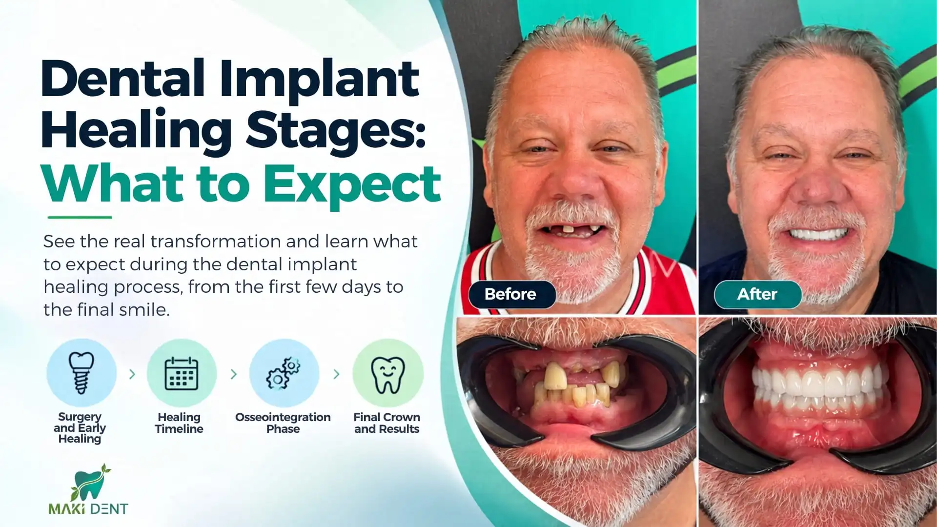 Dental implant surgery and early healing in Antalya, Turkey 