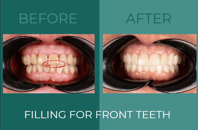 Before and After Filling for Front Teeth