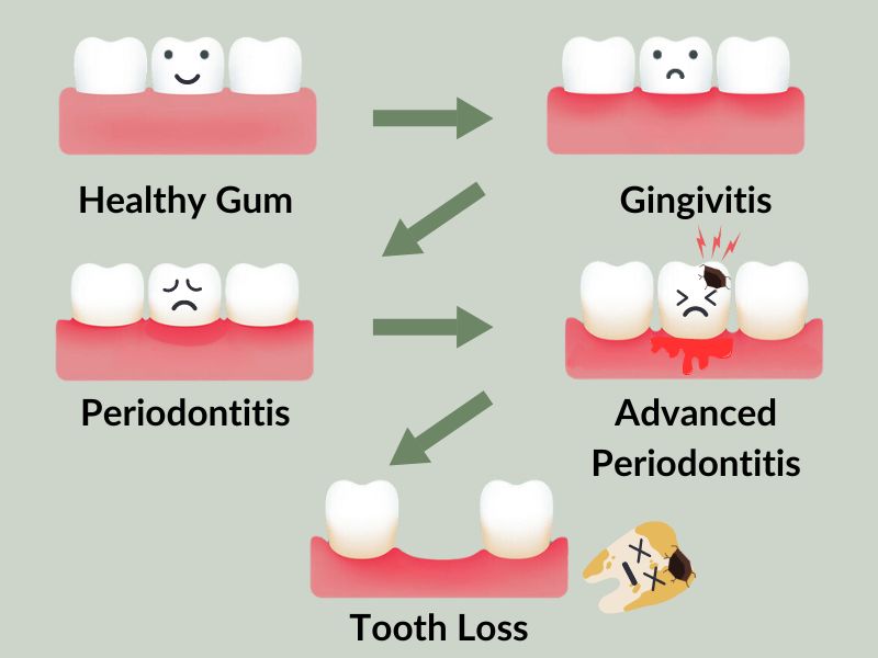 How Far Can Gums Recede Before Teeth Fall Out?