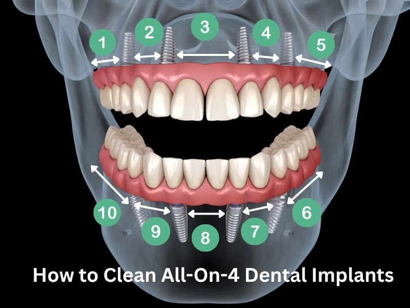 How to Clean All-On-4 Dental Implants