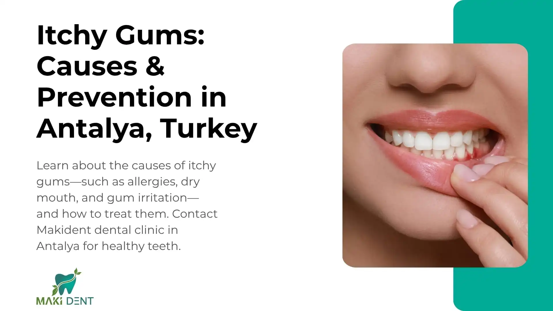 Itchy Gums: Causes & Prevention in Antalya, Turkey 