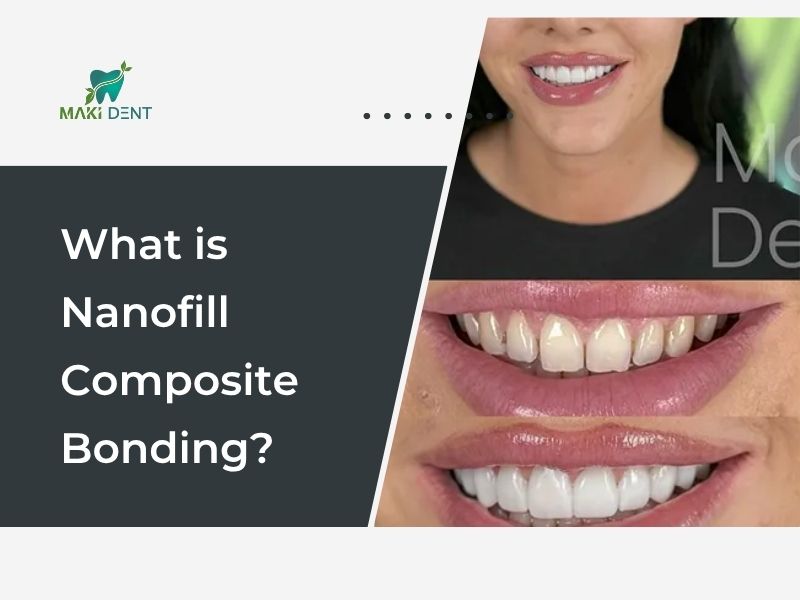 What is nanofill composite bonding?
