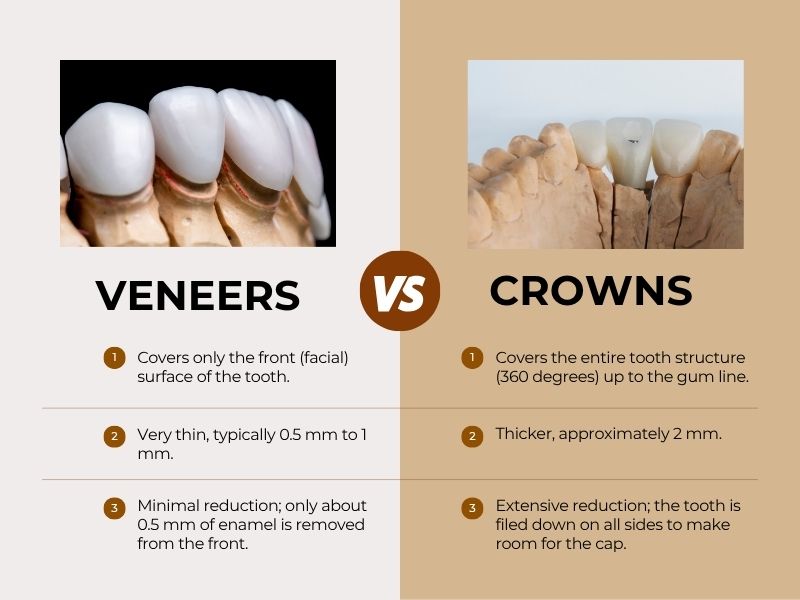 Veneers vs Crowns