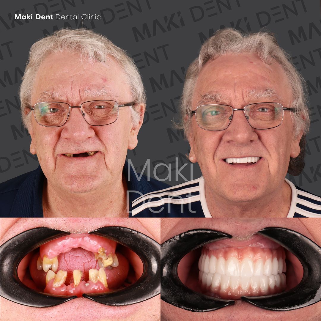 Before and after all-on-4 dental implants Turkey