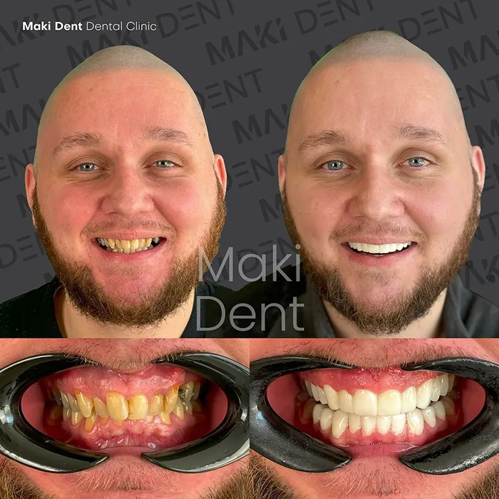 full mouth dental implants before after image