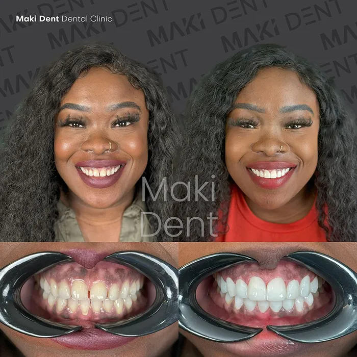 full mouth dental implants before after image