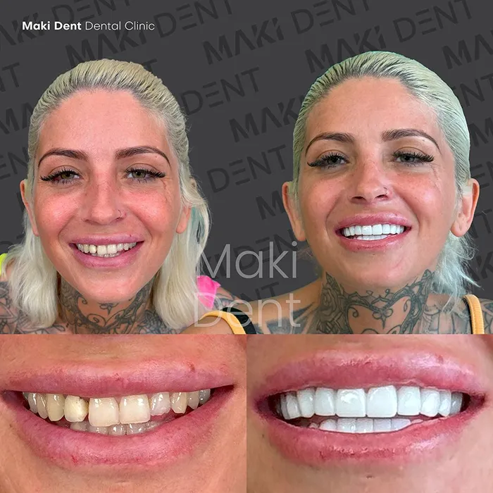 full mouth dental implants before after image