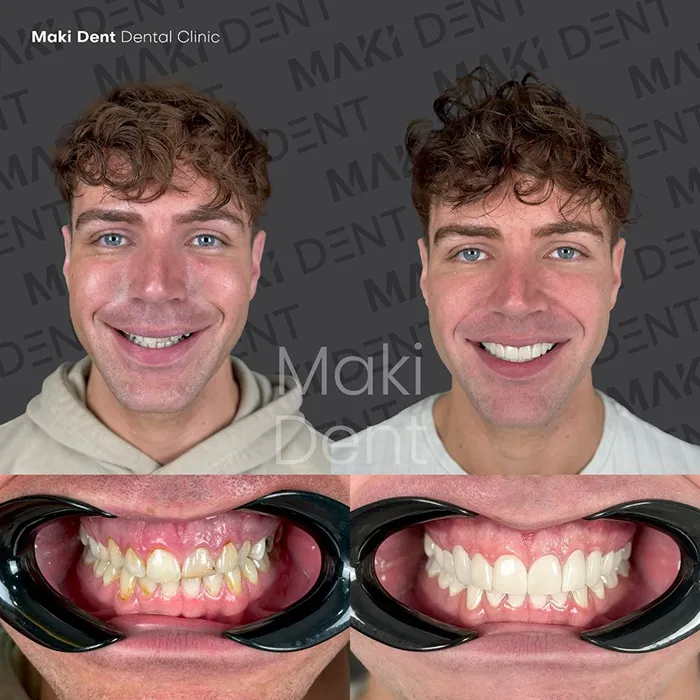 full mouth dental implants before after image