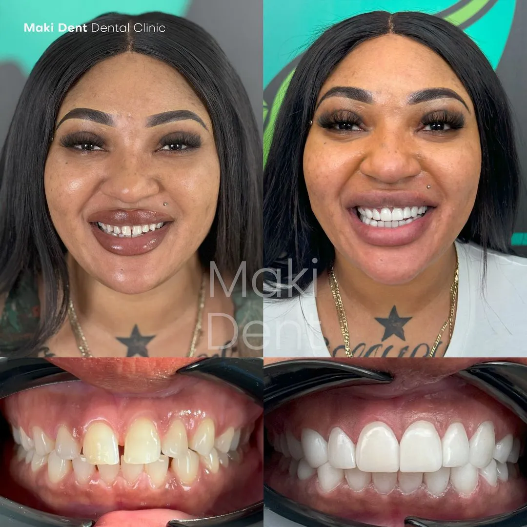 full mouth dental implants before after image