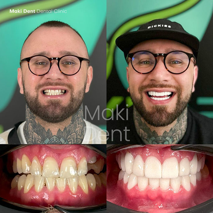 dental crown antalya before after image