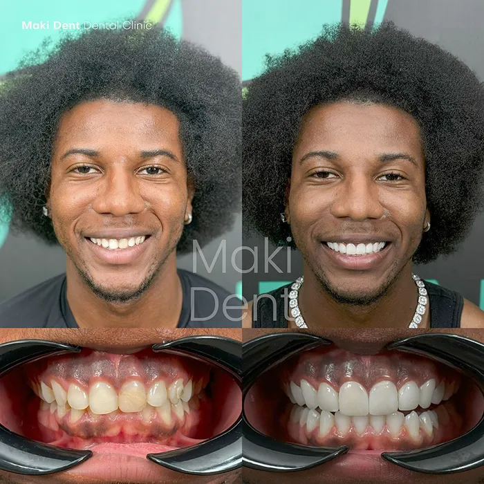 dental treatment before after image