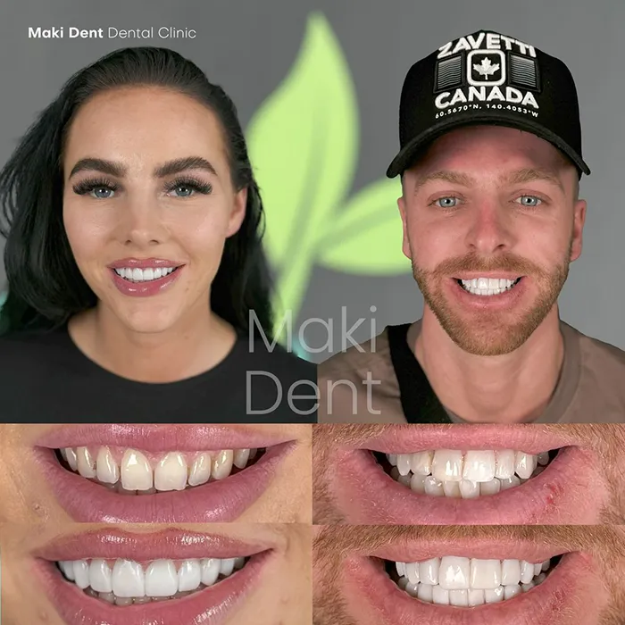 laminate-veneers before after image