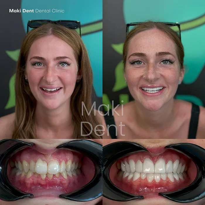 dental crown before after image