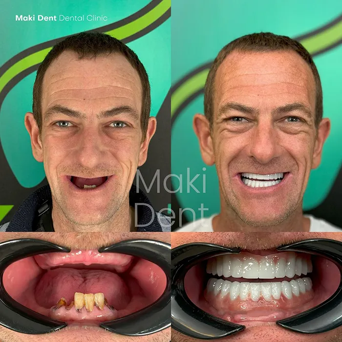 dental veneer before after image