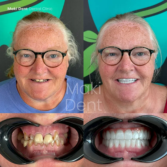 dental implant before after image