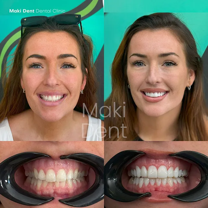 all on 4 dental implants before after image