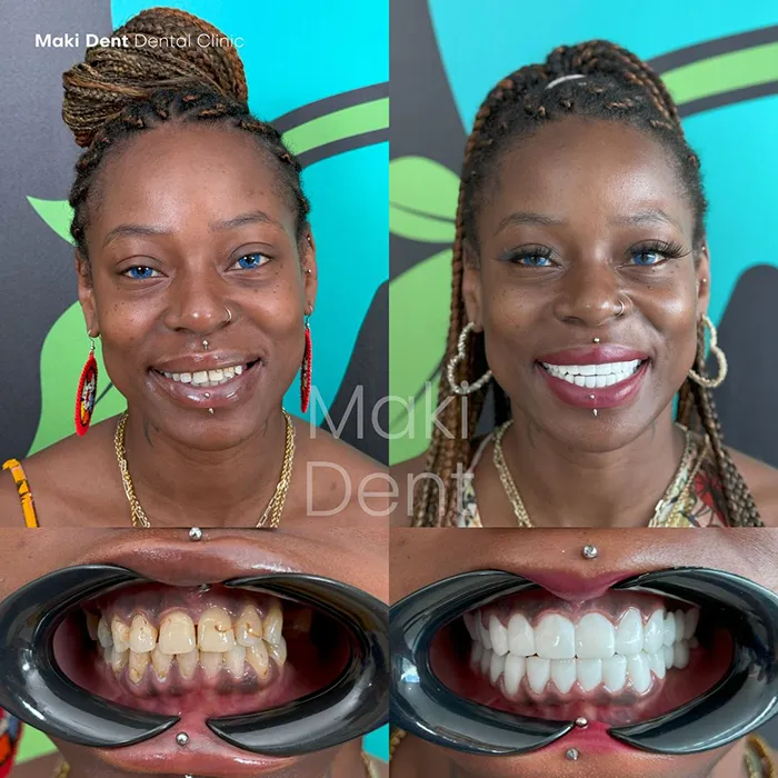 full mouth dental implants before after image