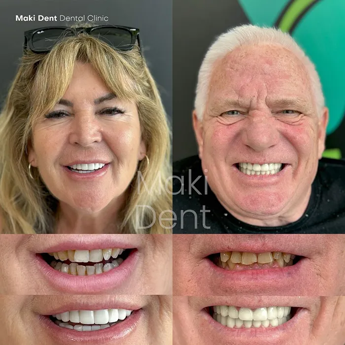 full mouth dental implants before after image