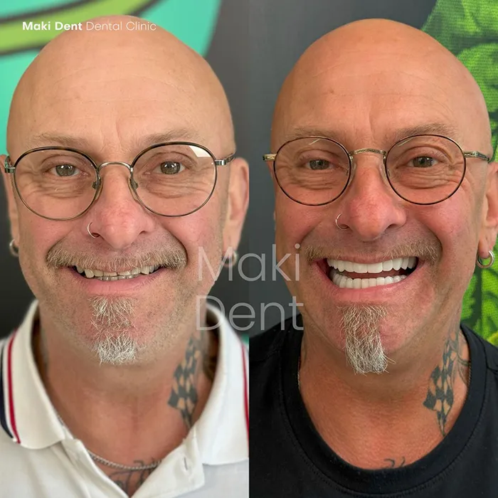 full mouth dental implants before after image