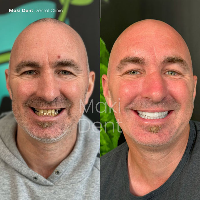 full mouth dental implants before after image