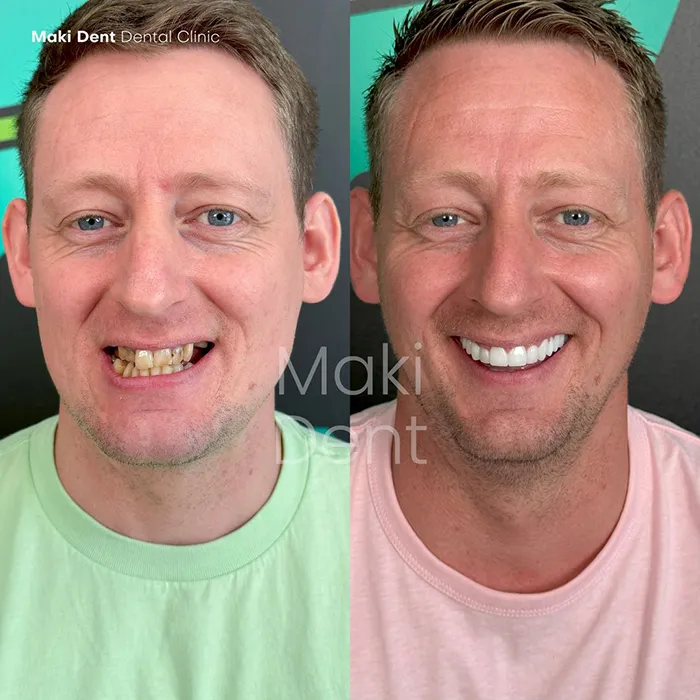 full mouth dental implants before after image