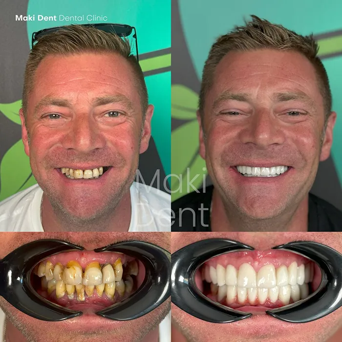 full mouth dental implants before after image