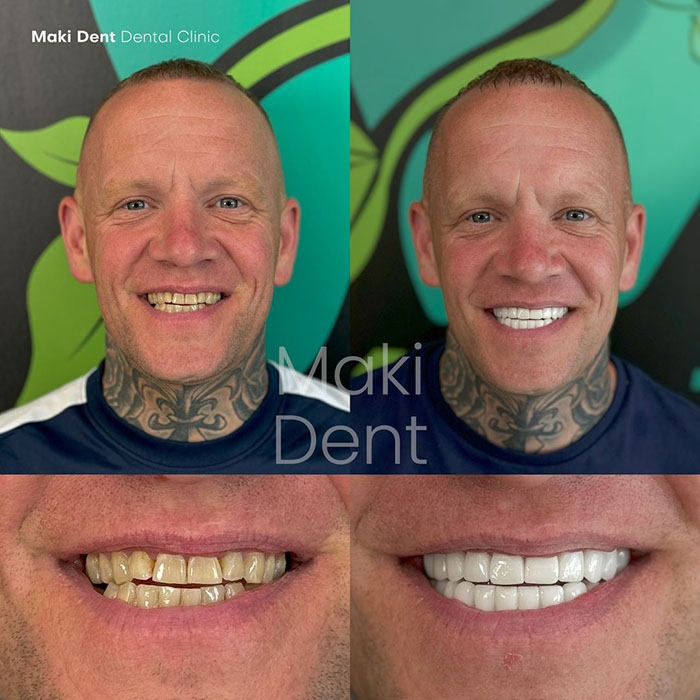 full mouth dental implants before after image