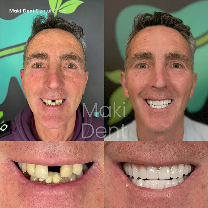 full mouth dental implants before after image