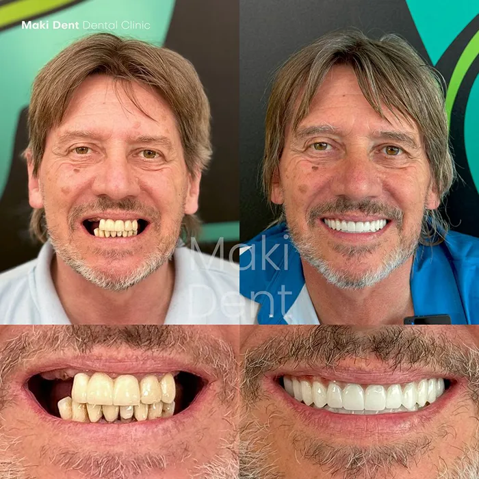 full mouth dental implants before after image