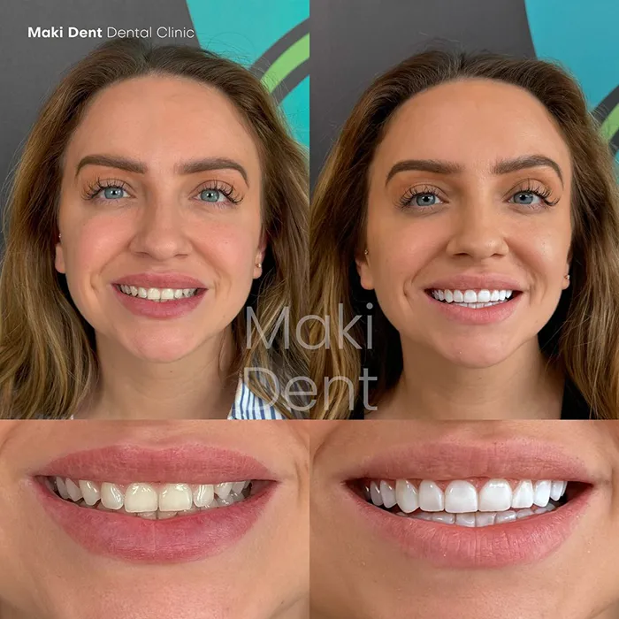 full mouth dental implants before after image