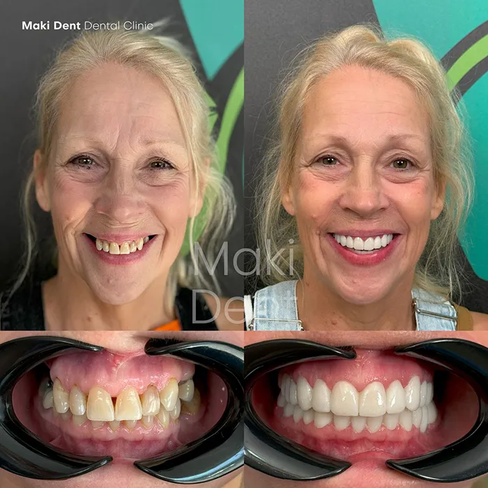 full mouth dental implants before after image