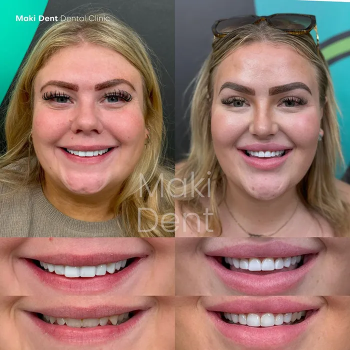 full mouth dental implants before after image