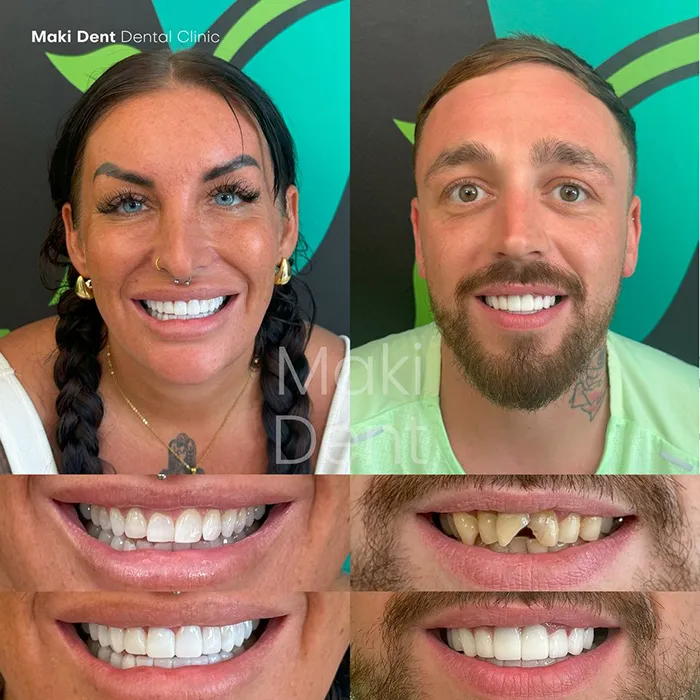 full mouth dental implants before after image