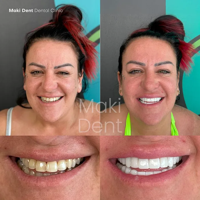 full mouth dental implants before after image