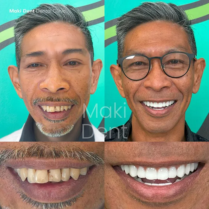 full mouth dental implants before after image