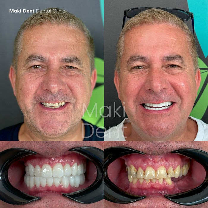 full mouth dental implants before after image