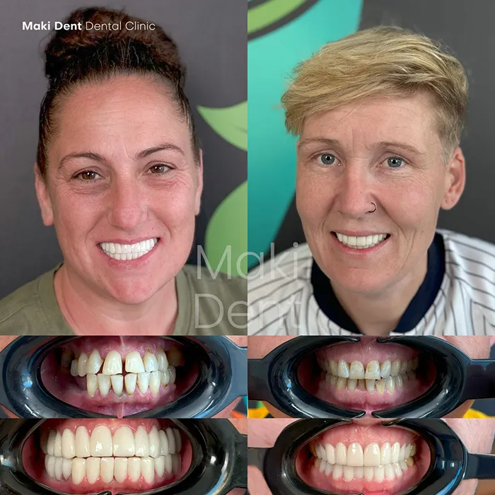 full mouth dental implants before after image